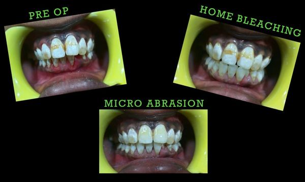 Home bleaching with microabrasion